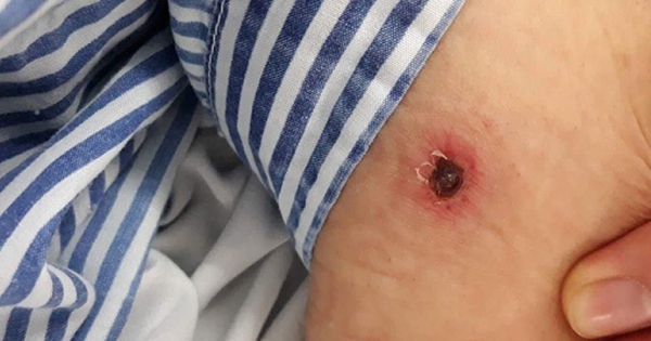 Sốt mò: Nguy hiểm đến tính mạng nếu bỏ qua