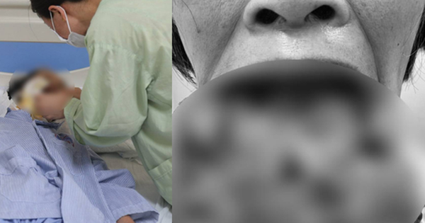 Người phụ nữ tự chữa khối u môi dưới lở loét với phương pháp ăn thực dưỡng độc đáo