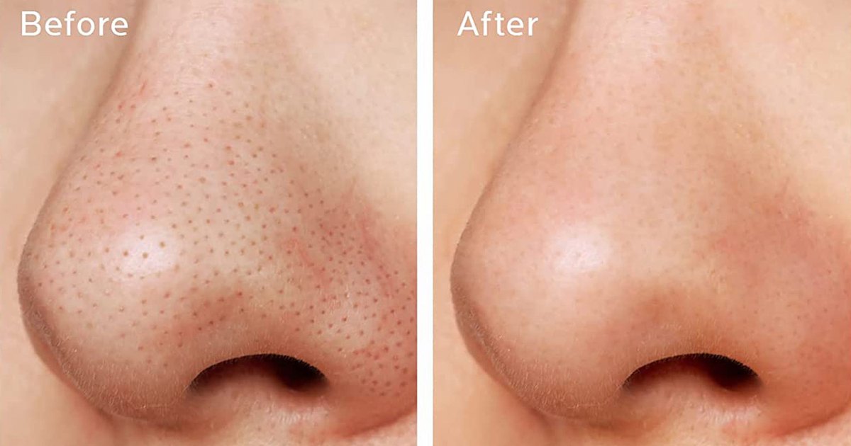 Bye Bye Blackheads: The Ultimate 3-Step Pore Kit for a Fresh-Faced Glow - 20% Off
