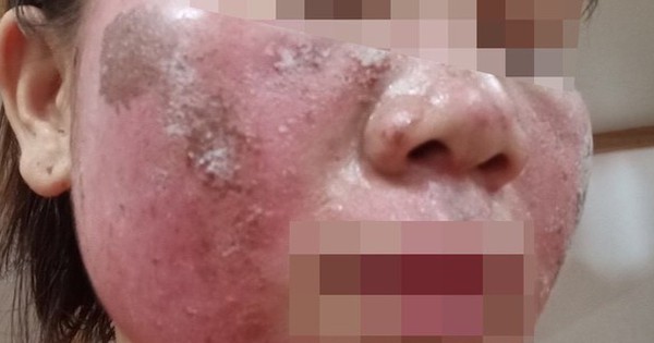 Bất ngờ với kết quả sau 2 tuần dùng kem peel da trên mạng