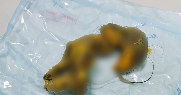 Bé gái 4 tuổi phát hiện búi tóc khổng lồ trong ruột non: Kinh ngạc vì nguyên nhân