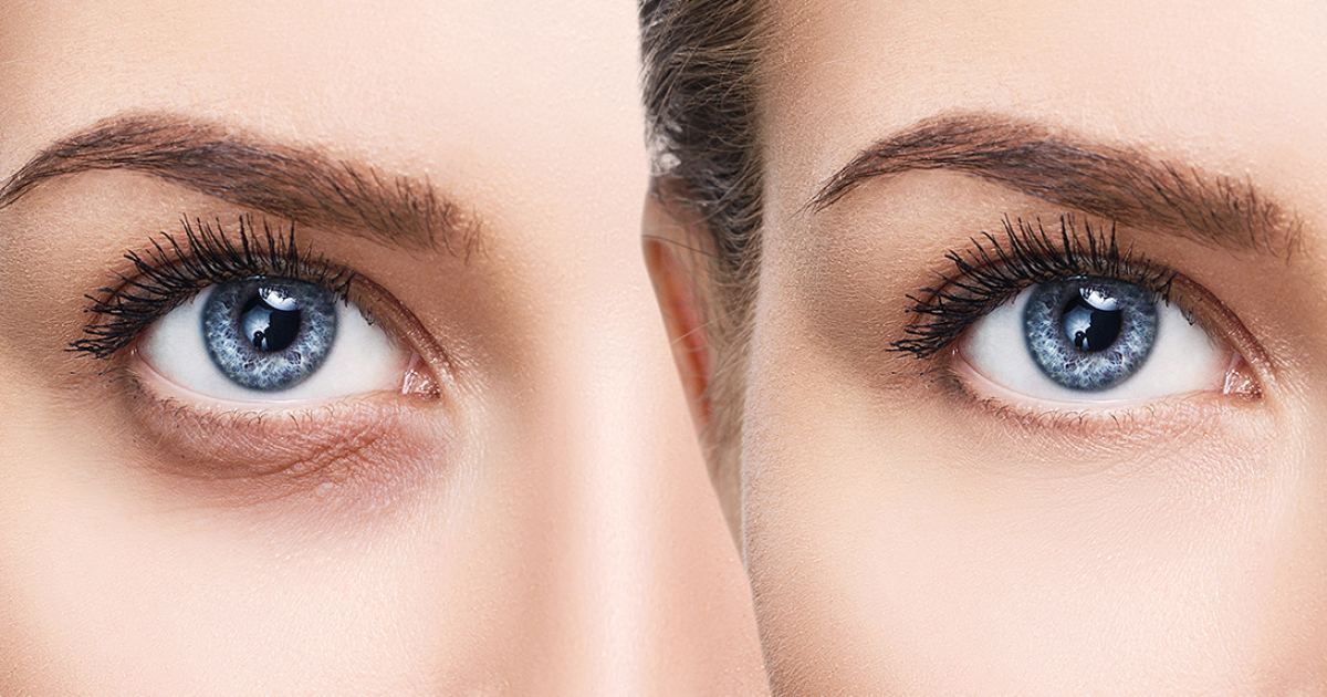 Say Goodbye to Puffy Eyes and Dark Circles with This Miracle Eye Gel