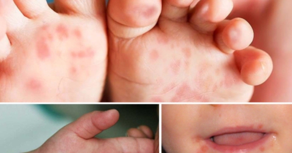 TPHCM: Số ca mắc tay chân miệng tăng chóng mặt trong tuần qua