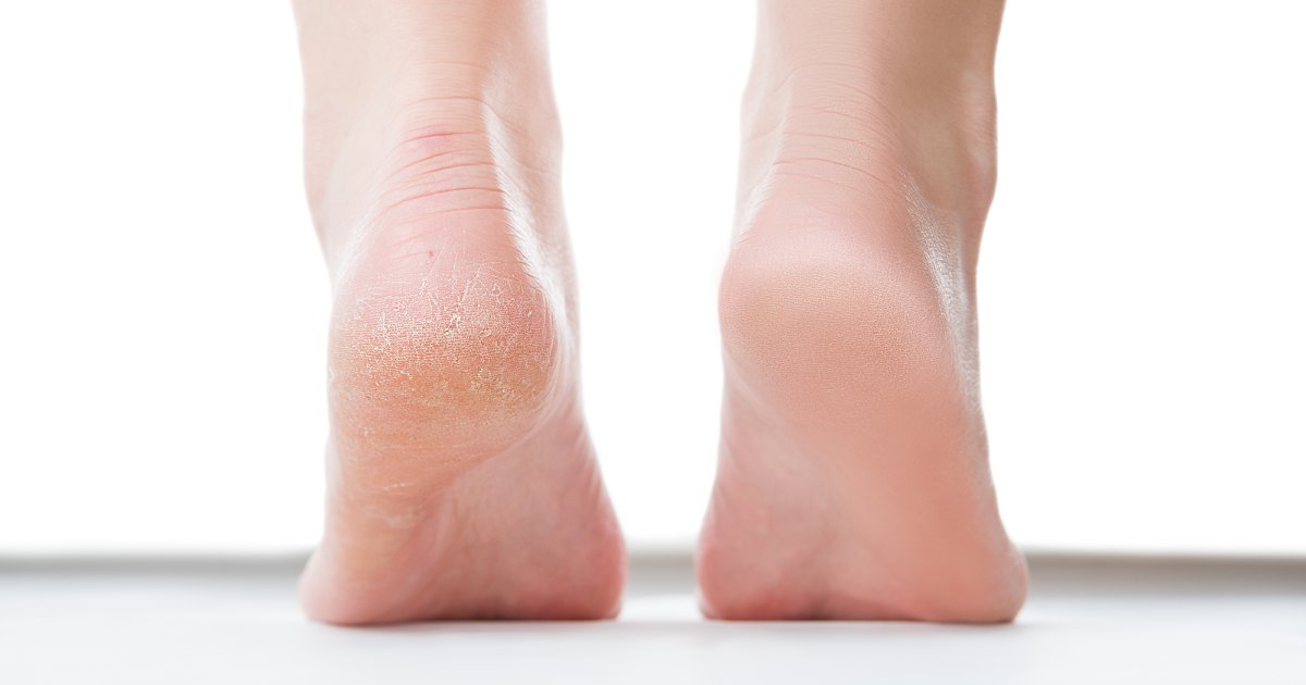 Instantly Transform Your Feet! This Miracle Heel Balm Rescues Dry, Cracked Skin (Limited Time Offer)