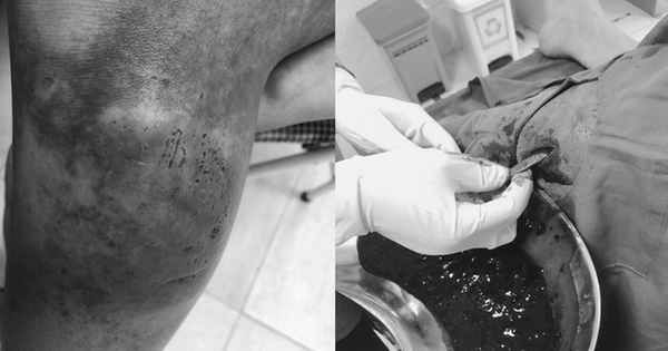 Cảnh báo: Mật gấu xoa bóp không đúng cách khi gặp chấn thương phần mềm