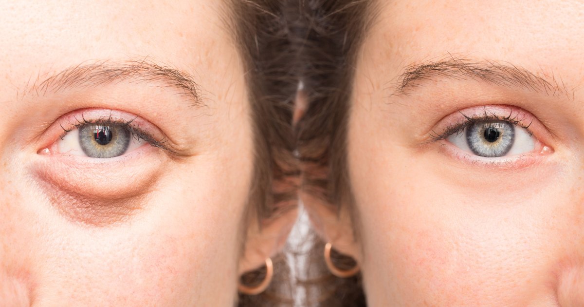 The Ultimate Solution to Banish Under-Eye Bags: Say Goodbye to Puffiness and Fine Lines!