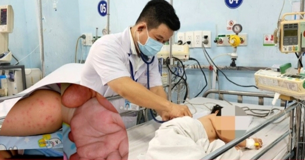 Biện pháp phòng ngừa và điều trị tay chân miệng hiệu quả, bảo đảm an toàn sức khỏe