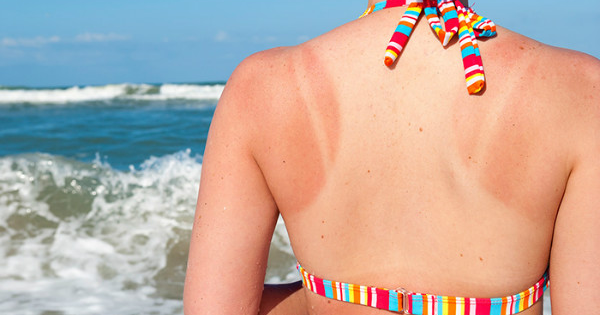 Làn da cháy nắng? 7 bí quyết phục hồi nhanh chóng cho làn da trắng mịn