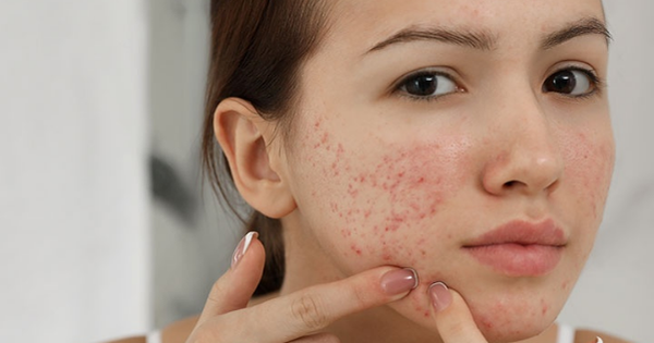 Khám phá bí quyết xóa sạch mụn hiệu quả vĩnh viễn