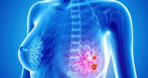 Bệnh nhân ung thư vú: Nguy cơ bị ung thư buồng trứng là thật hay sai?