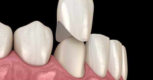 Bí quyết bọc răng sứ tuyệt vời để có nụ cười hoàn hảo!