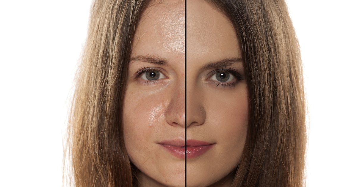 Bid Farewell to Oily Skin with this Must-Have Moisturizer