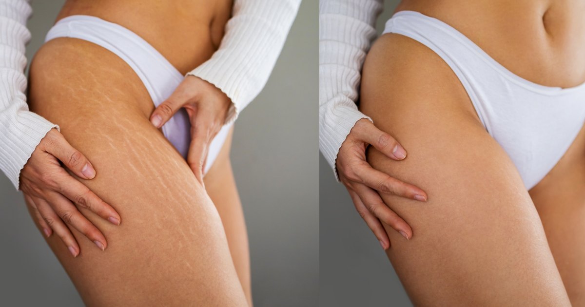 The Ultimate Stretch Mark Solutions Every 30-Something Woman Should Know