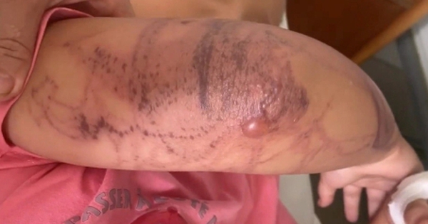 Bật mí cách trị đốt sứa biển khi tắm: Mẹo vô cùng hiệu quả để tránh tình trạng mất ý thức!