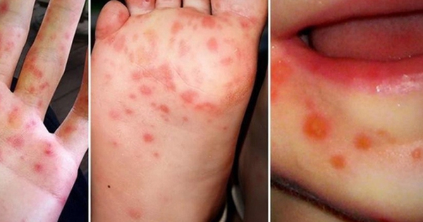 Ca mắc tay chân miệng ở Bình Dương: Số người nhiễm gia tăng đáng kể, ảnh hưởng sâu rộng