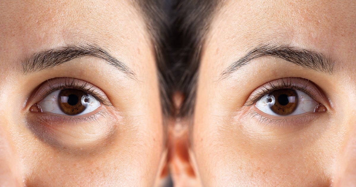 Unbeatable Offer: Get Your Hands on the Ultimate Icy-Cool Eye Stick for Only $10!