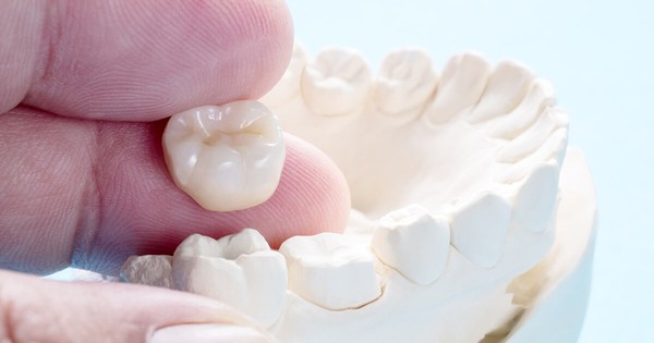 Bí quyết chọn răng sứ thẩm mỹ phù hợp dành cho bạn