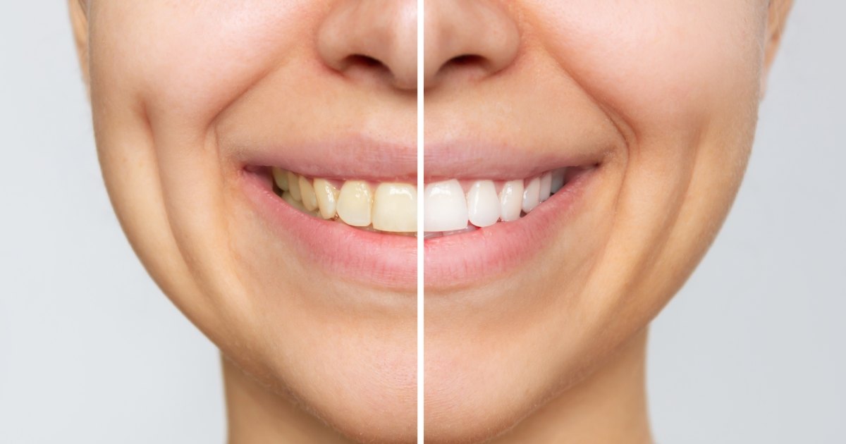 Discover the Ultimate Plaque Remover that Brings Back Radiant Smiles!