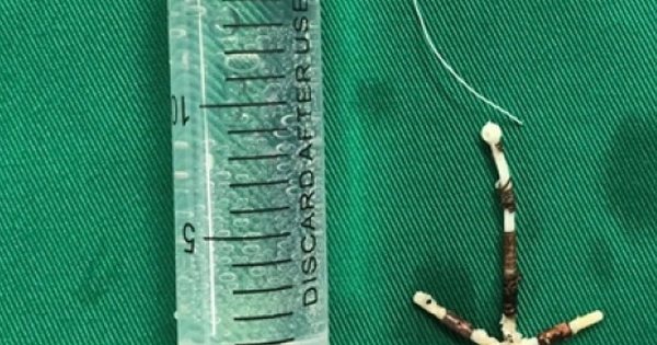 Phát hiện hy hữu: Bàng quang nữ bệnh nhân 40 tuổi bị đi lạc vòng tránh thai