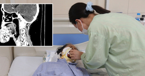 Phương pháp thực dưỡng - liệu có khả năng chữa khối u di căn từ môi xuống hàm?