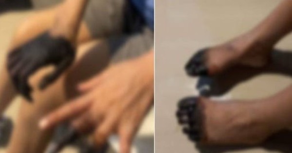 Tragedy Strikes: Người phụ nữ bị cắt mất gần hết ngón tay, chân trong lúc nằm viện chữa tiêu chảy