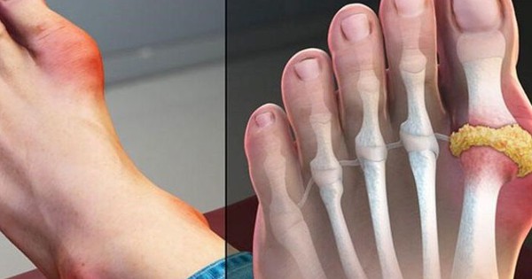 Cơn đau gout: Bí quyết dập tắt đau dữ dội không thể bỏ qua