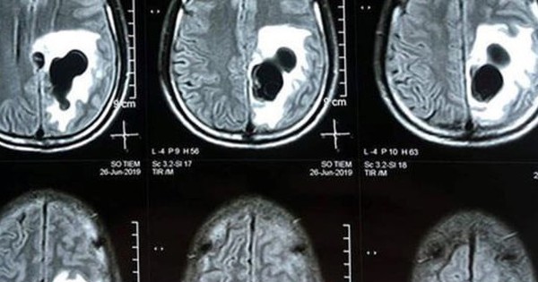 Sự thật bất ngờ: Sán đáng kinh ngạc tổ trong não của con người