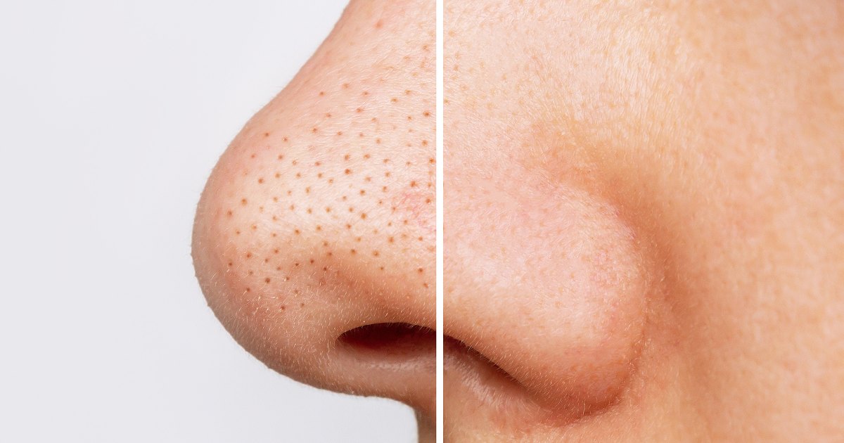 Unveiling the Breakthrough Solution: A High-Performance Blackhead Treatment at an Unbelievable $9!