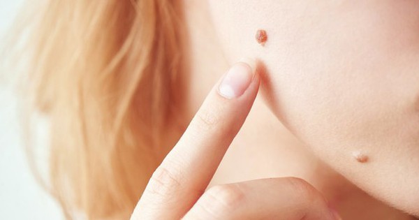 10 dấu hiệu trên nốt ruồi: Bảo vệ sức khỏe và phòng ngừa ung thư