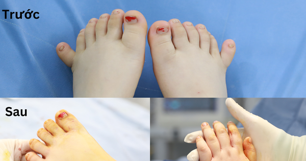 Phát hiện em bé với 12 ngón tay, 12 ngón chân - Một hiện tượng độc đáo!