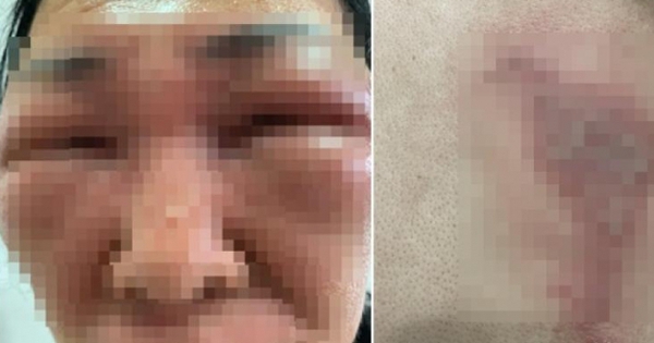 Kỹ thuật bắt côn trùng đột phá: Chỉ 1 giây, hai vợ chồng tái mở được mắt