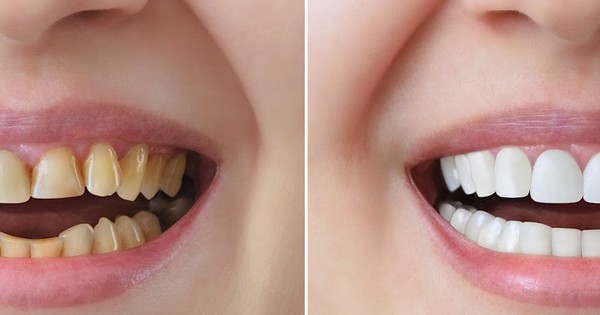 Khám phá phương pháp bọc răng sứ tối ưu: Lựa chọn nào thích hợp cho bạn?