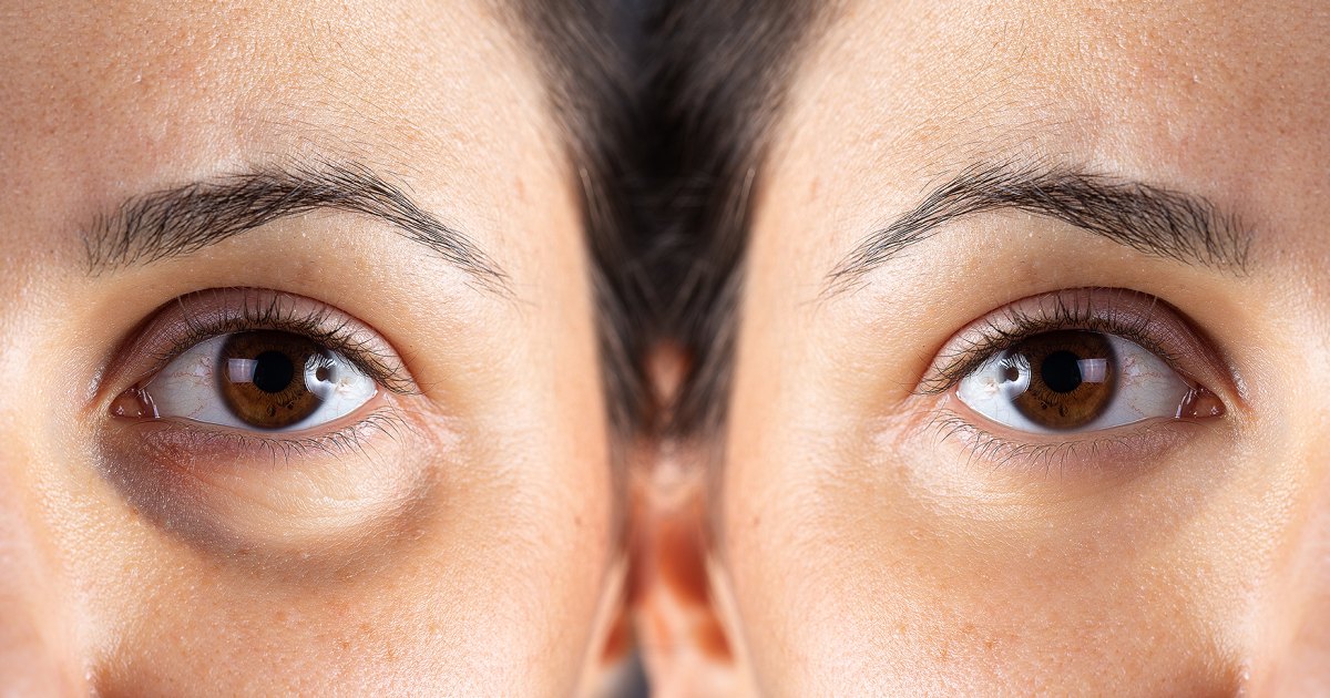 Experience Astonishing Results in Just 3 Days with This Extraordinary Eye Cream