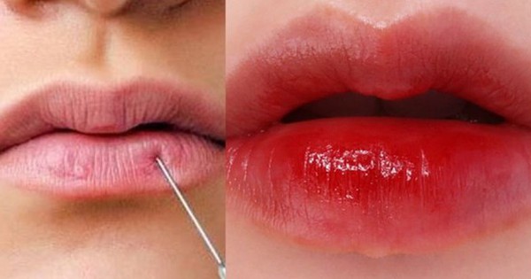 Lời khuyên quan trọng về filler môi: Tránh tắc mạch máu đáng lo ngại!
