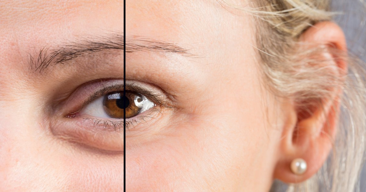 Ultimate Dark Circle Correcting Treatments: Uncover the Hottest Deals on Amazon Prime Day 2023!