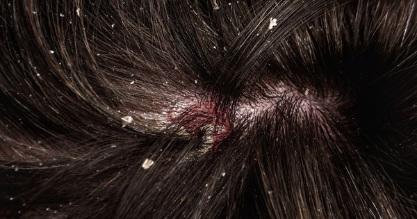 Chọn dầu gội thông minh để chấm dứt nỗi lo nấm da đầu