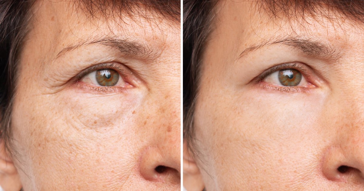 Revolutionary Eye Cream: Banish Puffiness and Wrinkles in a Lightning-Fast 15 Minutes!