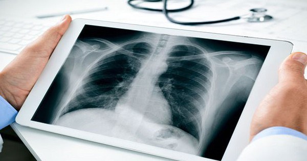 Hoạt động nguy hiểm hàng ngày có thể gây ung thư phổi - Bạn đã biết?