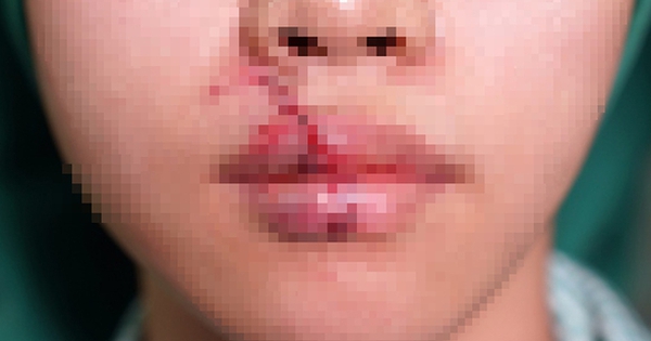 Cô gái bị thú cưng tấn công: Cách phục hồi nhanh và hiệu quả cho môi rách toạc